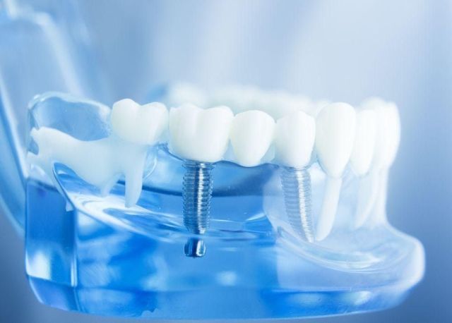 Приживаемость зубного импланта: что это и от чего зависит