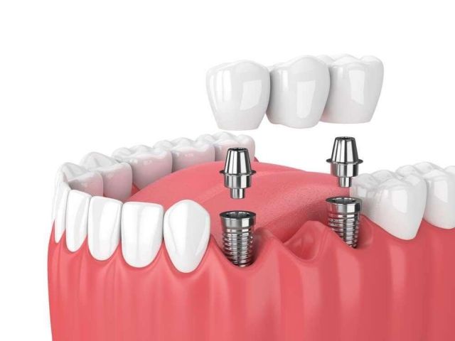 От чего зависит приживаемость зубного импланта
