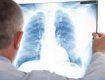 Закарпаття. Вжез 1 квітня хворі з закритою формою туберкульозу лікуватимуться у сімейних лікарів