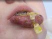 Решила сэкономить: 14-летняя украинка увеличила губы косметическим маслом 