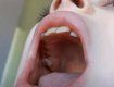 В Киевской области врачи вырвали ребенку одновременно 12 зубов и выставили нехилый счет (