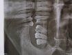Перелом челюсти и ушибы: На Закарпатье ромы напали на человека прямо в "АТБ"