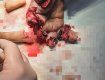 В Закарпатье 16-летний парень отрезал себе все пальцы на руке