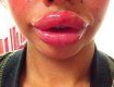 30-летняя дама потратила 2 000 фунтов на пластическую хирургию губ