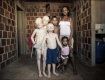 У чернокожих родителей родилось трое детей-альбиносов