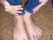 17-летняя ужгородка на обеих стопах ног имеет по 6 пальцев