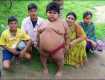 В Индии 5-летняя девочка весит 76 килограммов