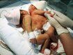 В Перу родились близнецы с одним сердцем на двоих