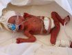 Медики Санкт-Петербурга чудом спасли малышку, родившуюся весом меньше половины килограмма