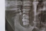 Перелом челюсти и ушибы: На Закарпатье ромы напали на человека прямо в "АТБ"