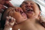 В Китае родилась девочка-мутант с двумя головами
