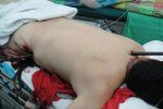 В Китае врачам удалось извлечь штырь из тела плотника