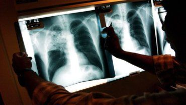 Чергові "поради" від Уляни Супрун: як захиститися від туберкульозу