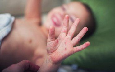 В Одесской области от кори умер 5-месячный ребенок