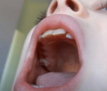 В Киевской области врачи вырвали ребенку одновременно 12 зубов и выставили нехилый счет (