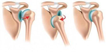 Вывих плечевого сустава связан с большими нагрузками