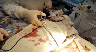 Унікальну операцію провели українські хірурги