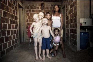 У чернокожих родителей родилось трое детей-альбиносов