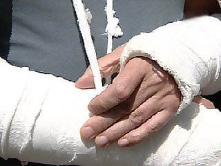 Донецкие милиционеры сломали мужчине обе руки