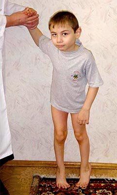 В Украине много детей с церебральным параличом