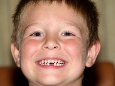 В Ужгороде внедряют программу оздоровления зубов детей