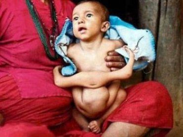 В Непале родился ребенок с четырьмя руками и ногами