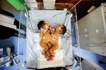 В Словакии сиамские близнецы умерли после операции