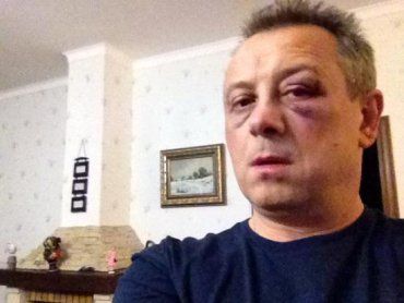 Владимир Куренной показал, как отморозки "отрихтовали" его лицо