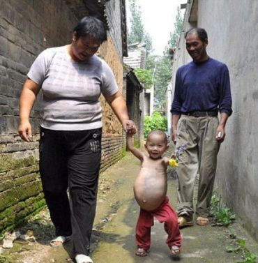 Полуторагодовалая китаянка носит в животе неродившегося близнеца