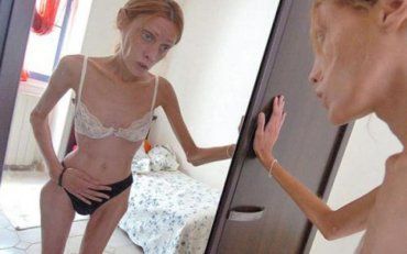 Вчені знайшли причину анорексії